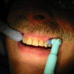 Dental crowns vs veneers